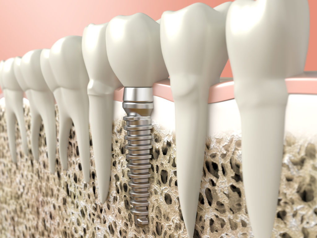Dental Implants Bone Grafting - Austin Tx