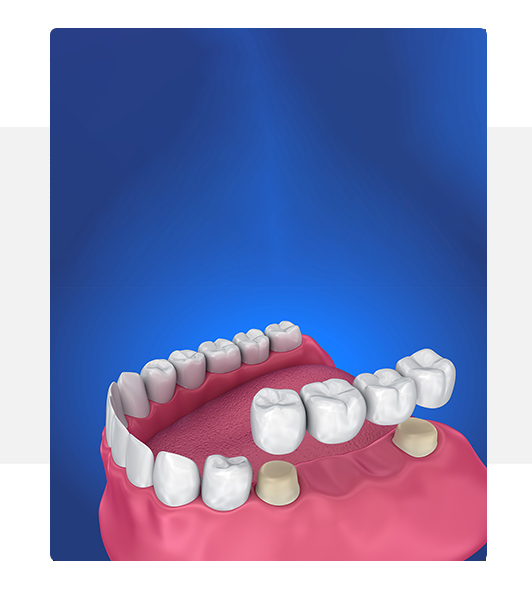 Dental Bridges - model - Austin, Tx