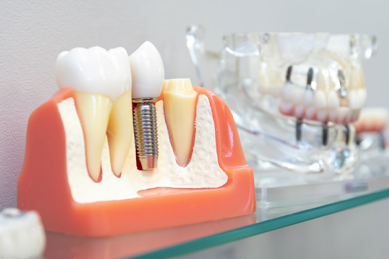 Dental Implant in Your Bone, Model