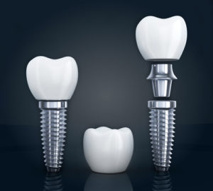 the three different parts of a dental implant