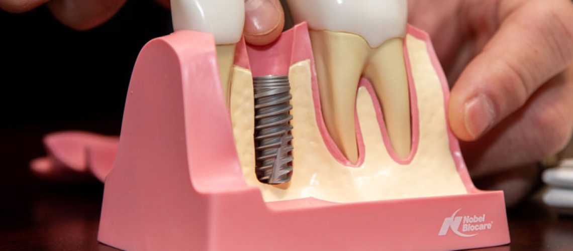 Dental Implant in Your Bone, Model