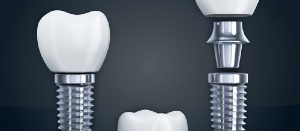 the three different parts of a dental implant