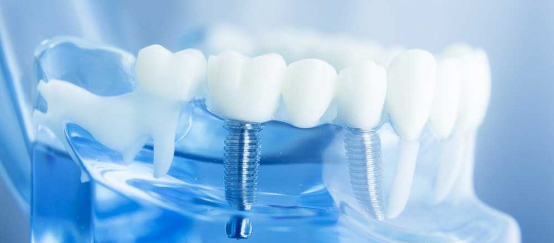 Steps to Properly Care for Your Dental Implants Austin, TX
