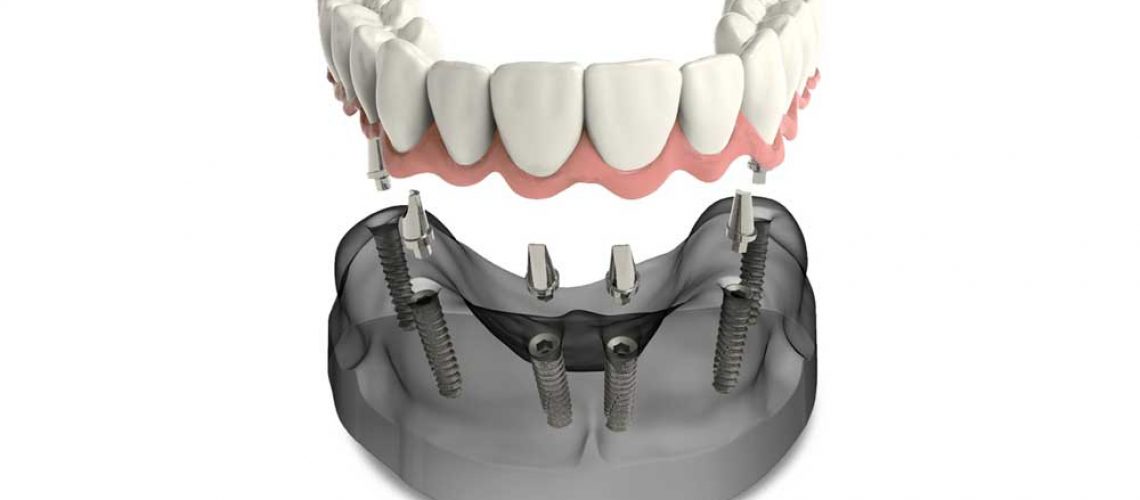 a model of implant supported dentures