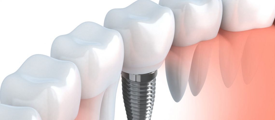What is a Dental Implant and What is it Used for?